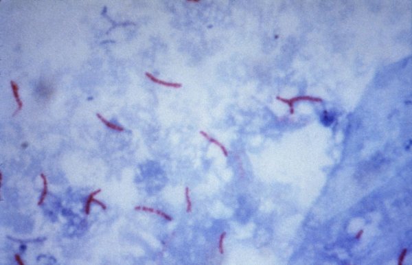 Учёные исследовали реакцию организма, которая поможет создать лекарство от туберкулёза